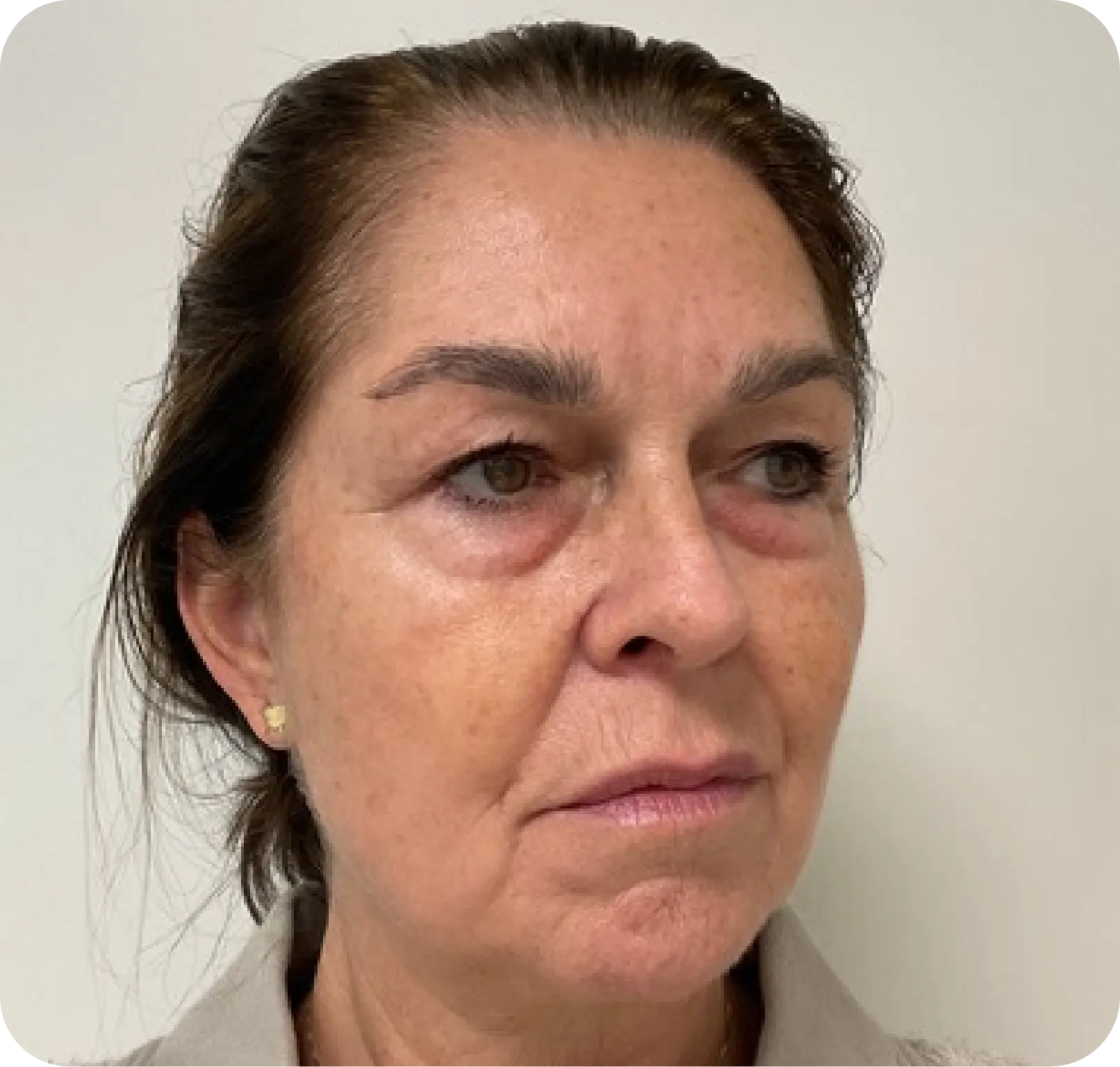 voor teruggetrokken kin